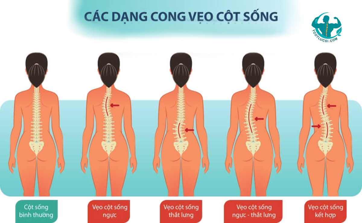 Các vị trí cong vẹo cột sống