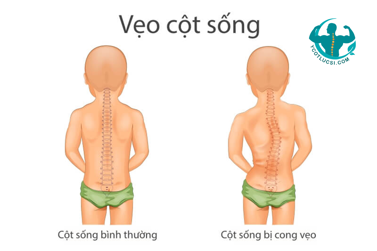 Vẹo cột sống là gì